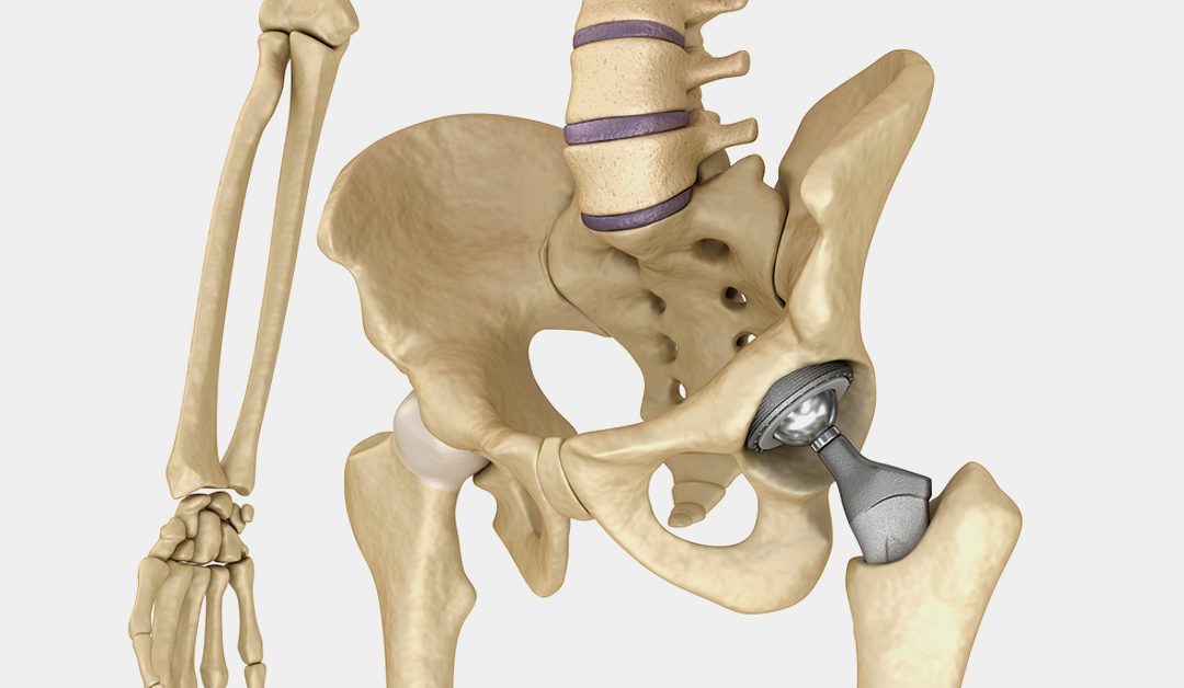 Hip Implant