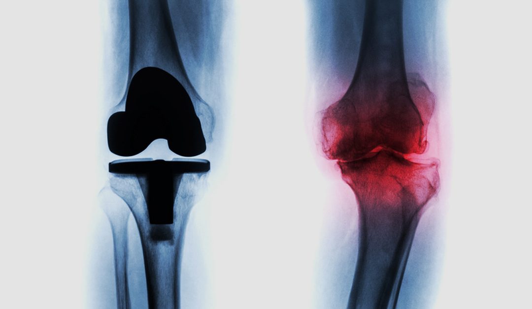 Knee Implant