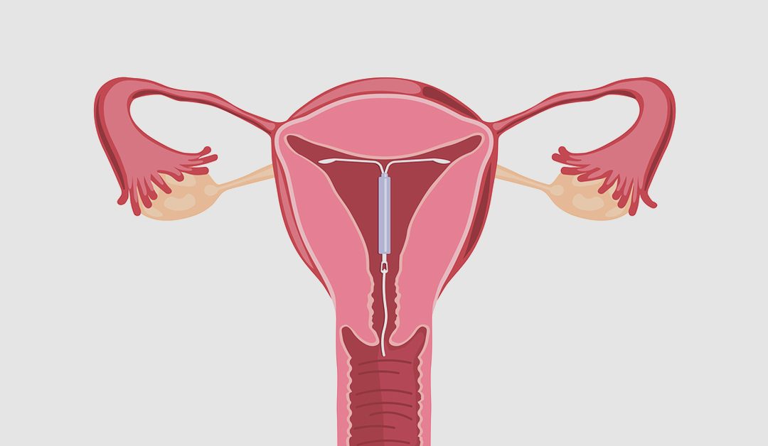 Mirena IUD